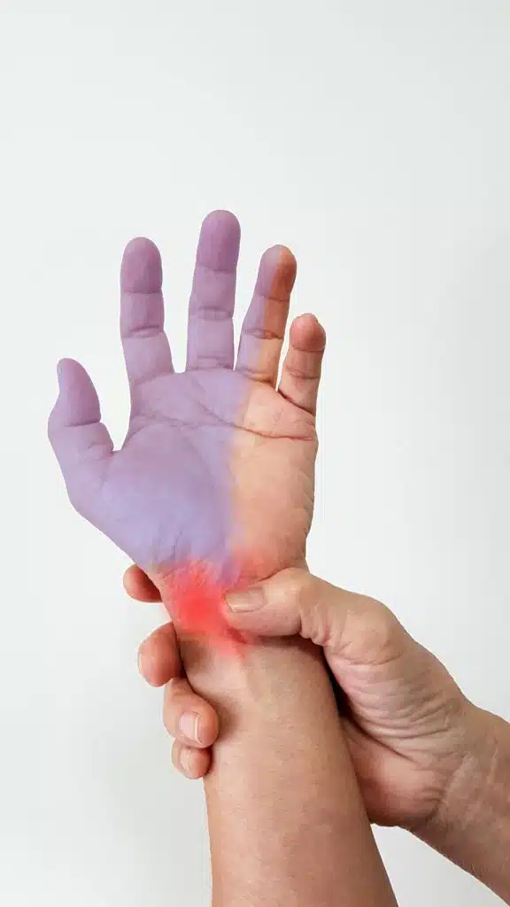 Carpal tunnel syndrome