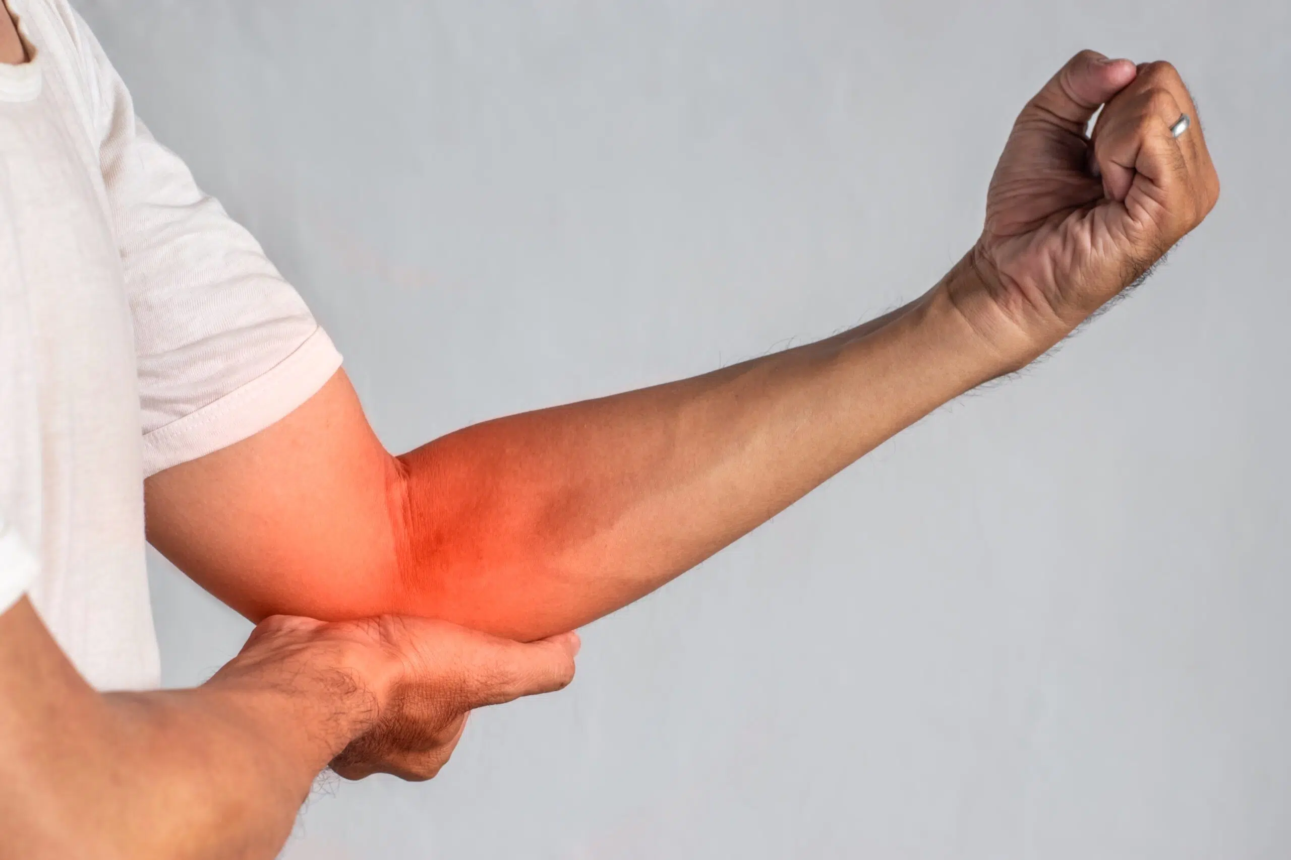 Cubital tunnel syndrome