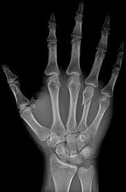 Hand fracture X-ray