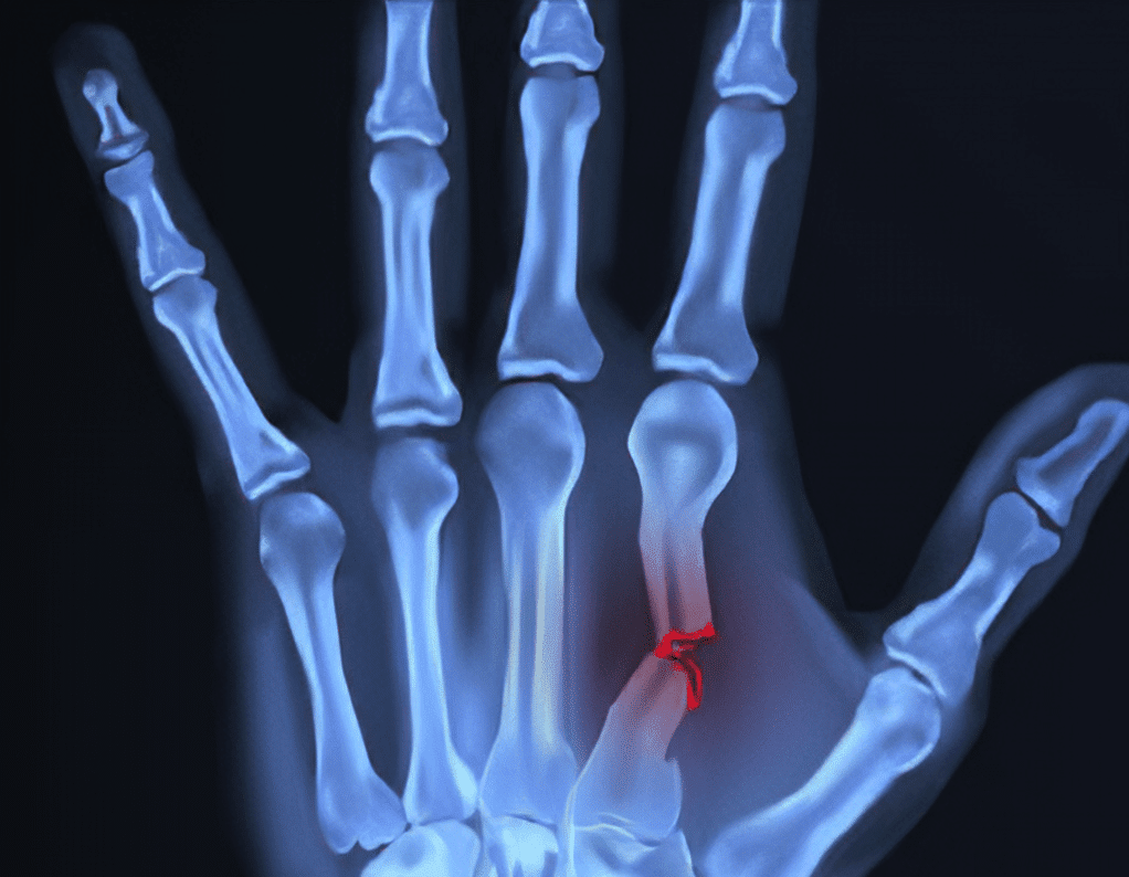 Hand fracture X-ray