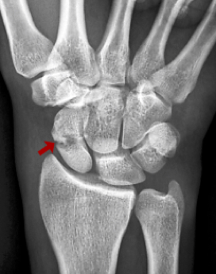 Scaphoid fracture