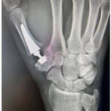 Touch CMC prosthesis — thumb joint replacement X-ray