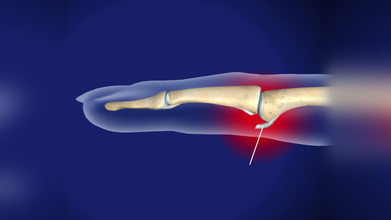 Volar plate injury — PIP joint anatomy diagram